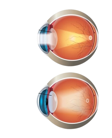 Cataract Surgery Procedure