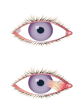 Pterygium Surgery Treatment